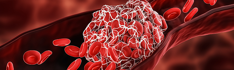 How to Prevent Serious Blood Clots