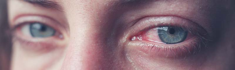 can allergies make your eyes red