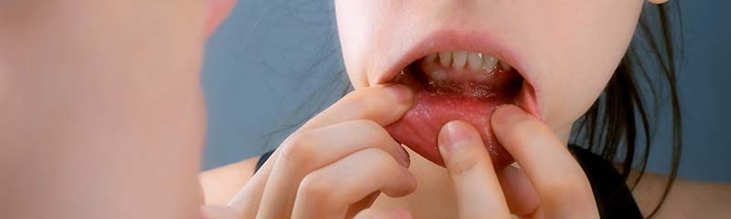 cure mouth ulcers fast naturally