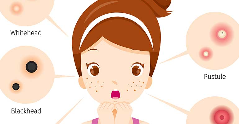 How to Get Rid Of Acne - Causes, Acne Medication, and More!