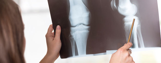 The Importance of Bone Health