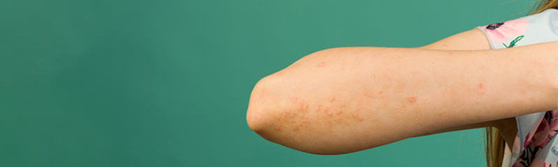 What Does Psoriasis Look Like – Symptoms and Treatment