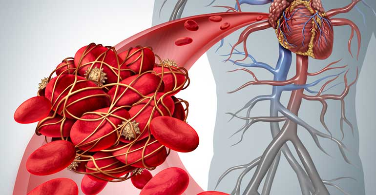 ¿Qué Ocasiona los Coágulos en la sangre y cuáles son los Síntomas?