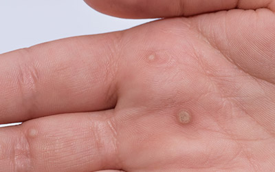 Cantharidin Wart