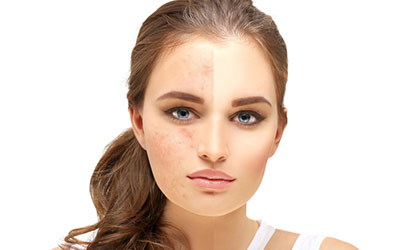 Differin Gel